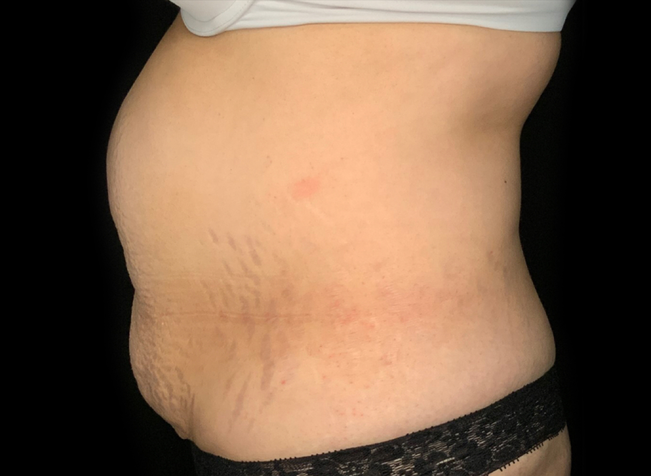 Patient #61240: Tummy Tuck Before Image