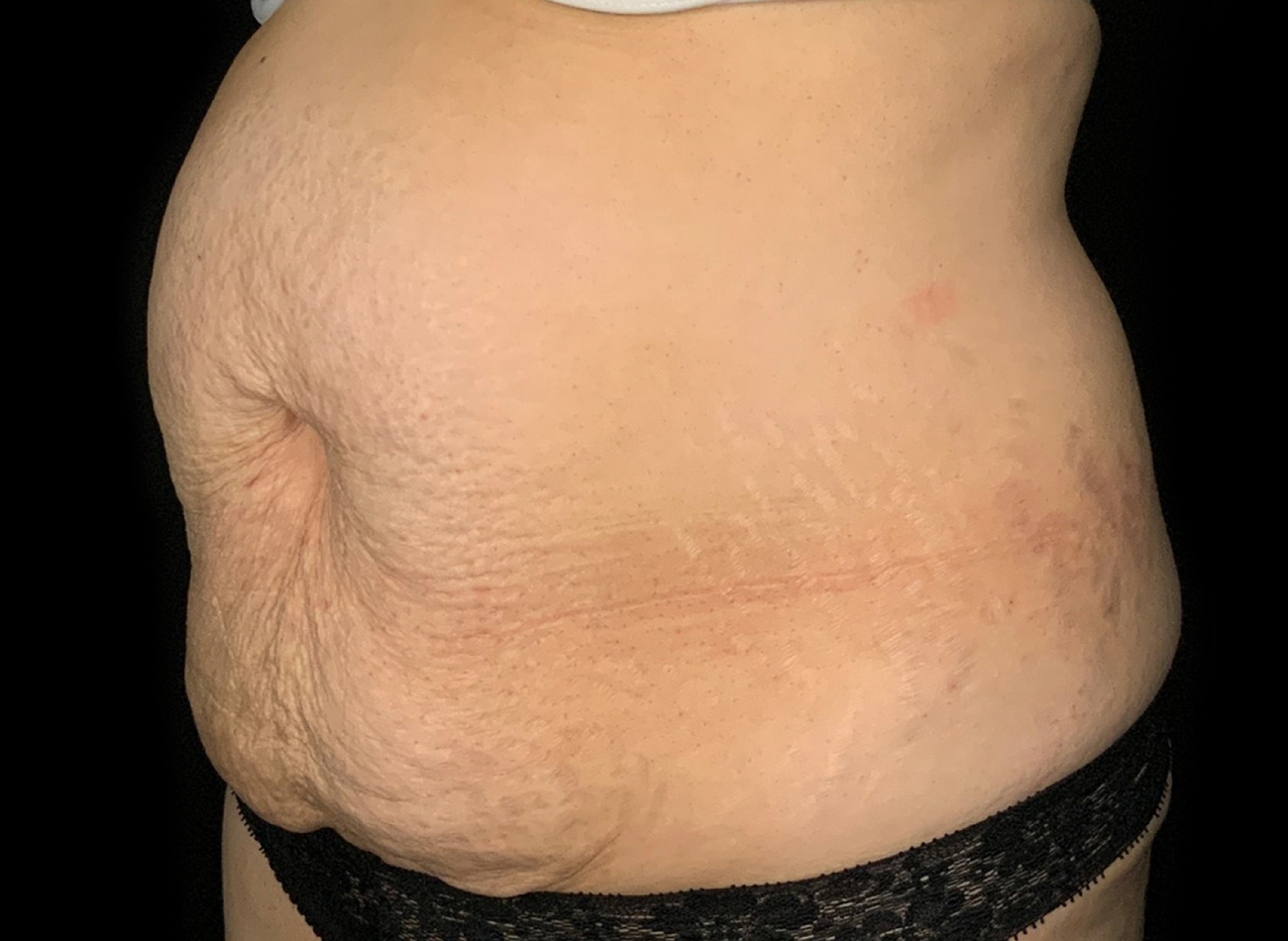 Patient #61240: Tummy Tuck Before Image
