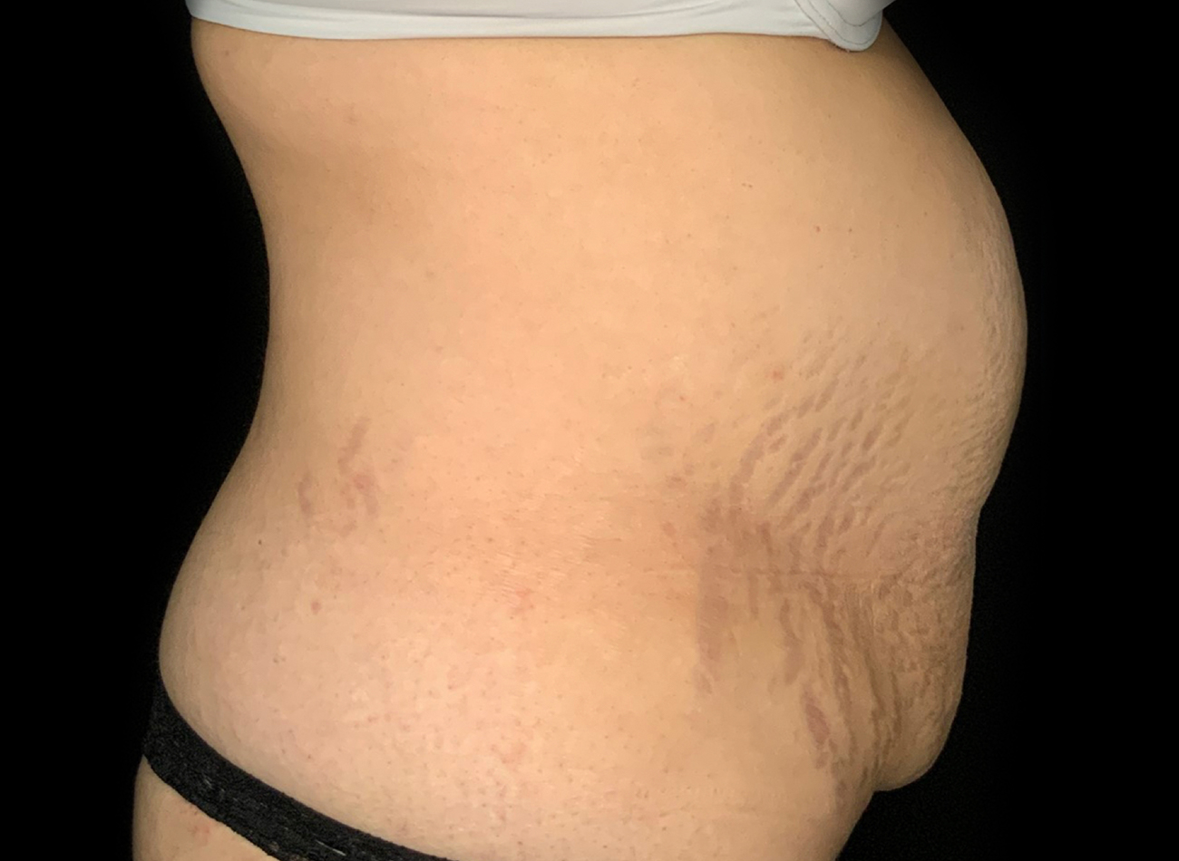 Patient #61240: Tummy Tuck Before Image