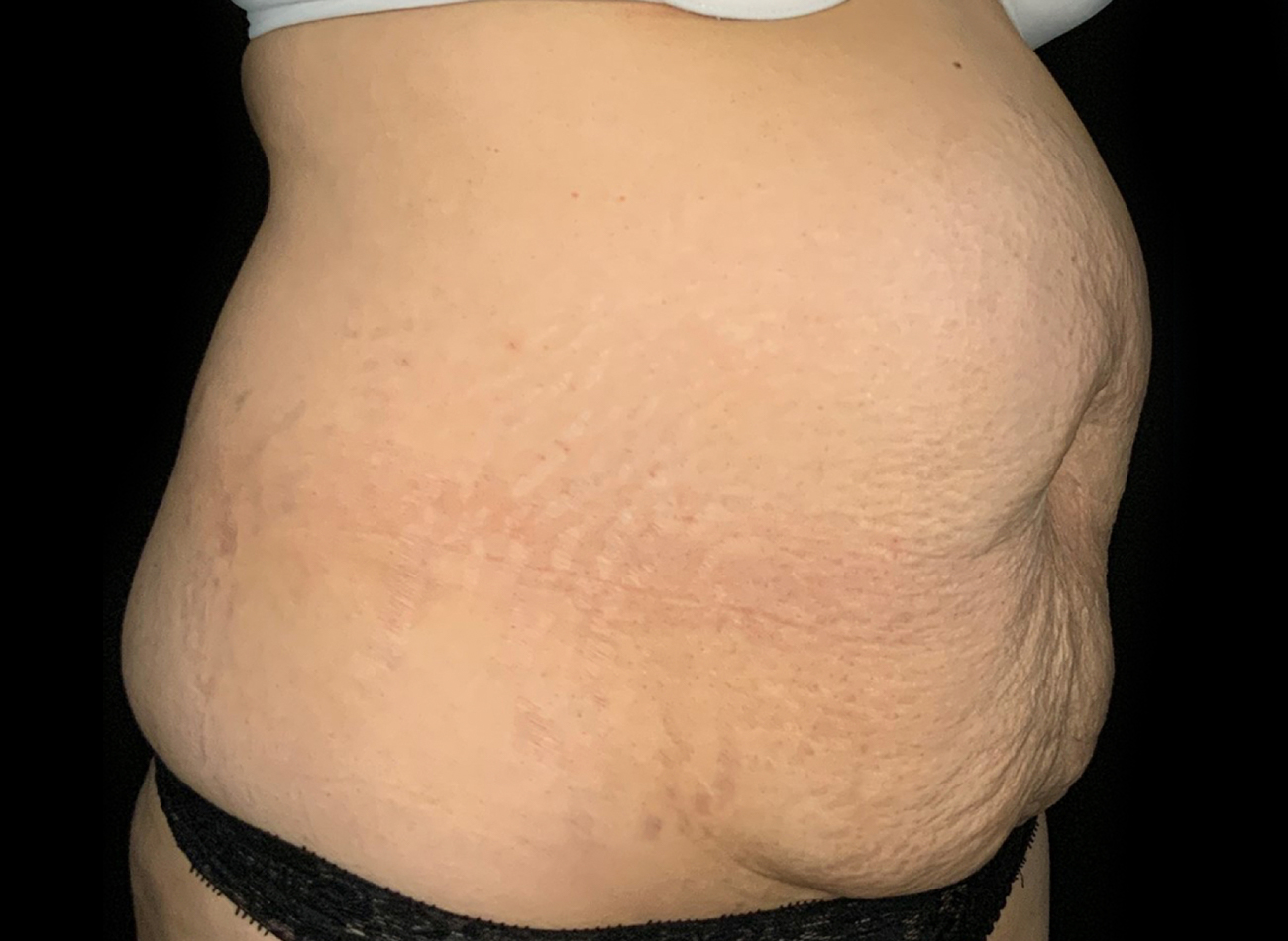Patient #61240: Tummy Tuck Before Image