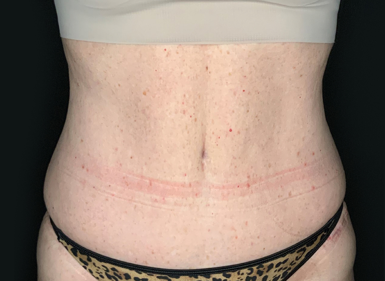 Patient #75588: Tummy Tuck After Image