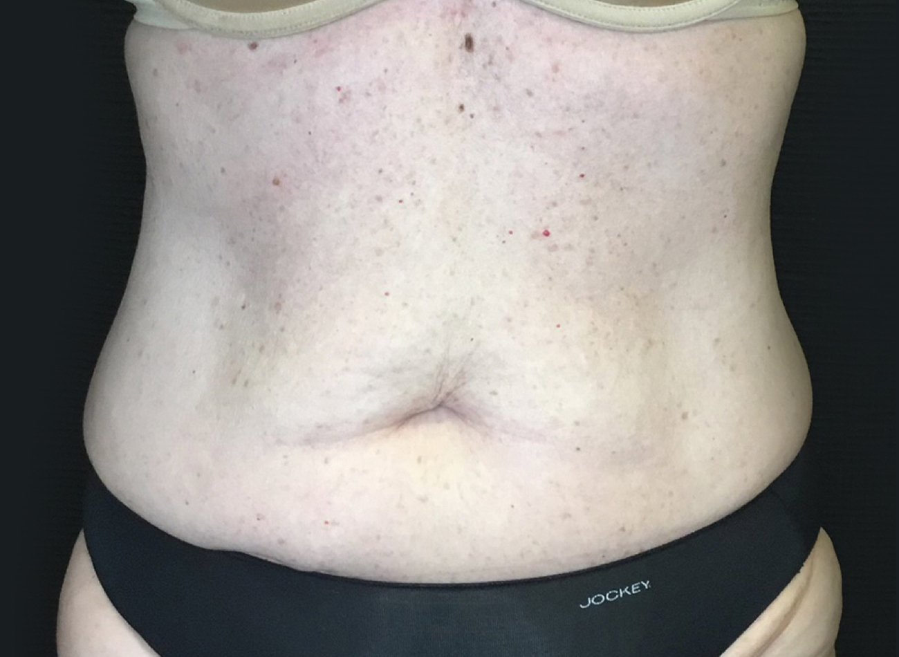 Patient #75588: Tummy Tuck Before Image
