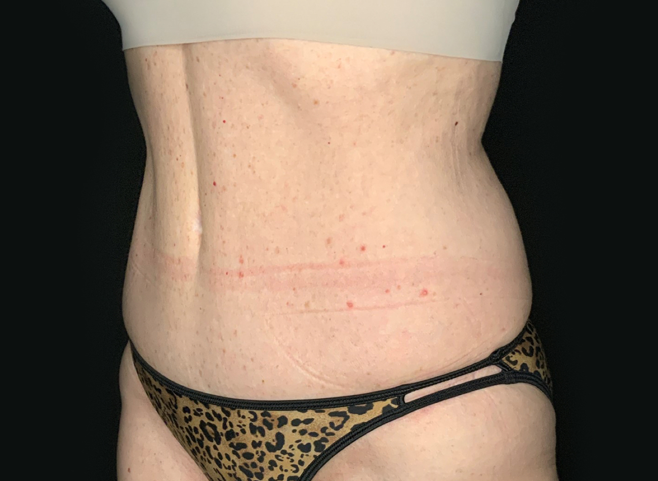 Patient #75588: Tummy Tuck After Image