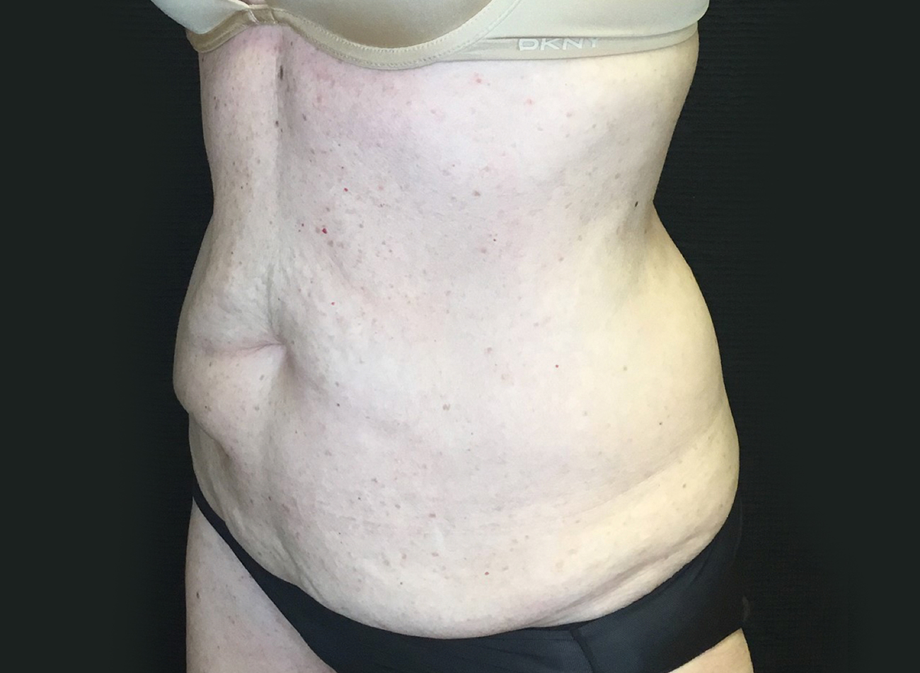 Patient #75588: Tummy Tuck Before Image