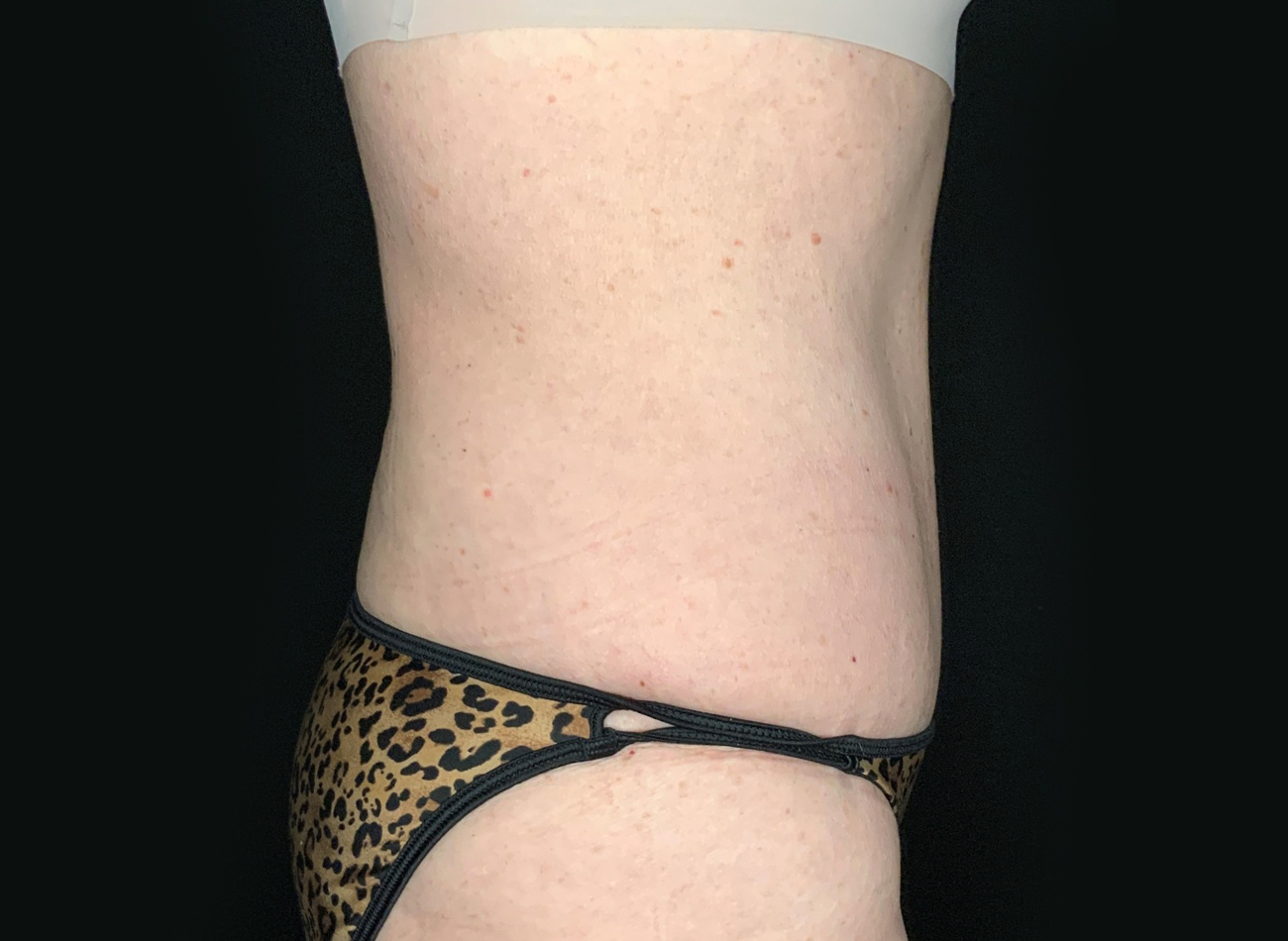 Patient #75588: Tummy Tuck After Image