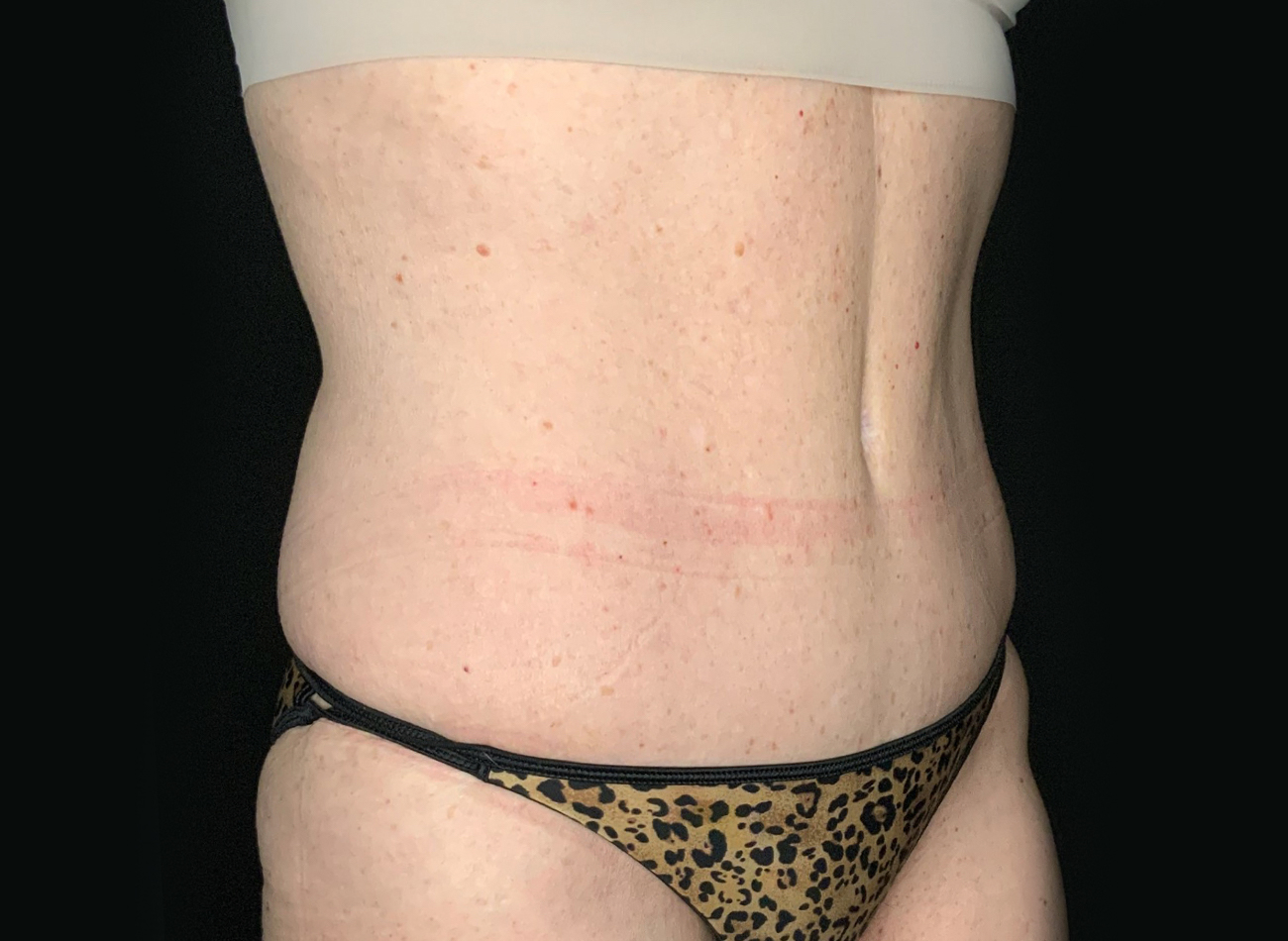 Patient #75588: Tummy Tuck After Image