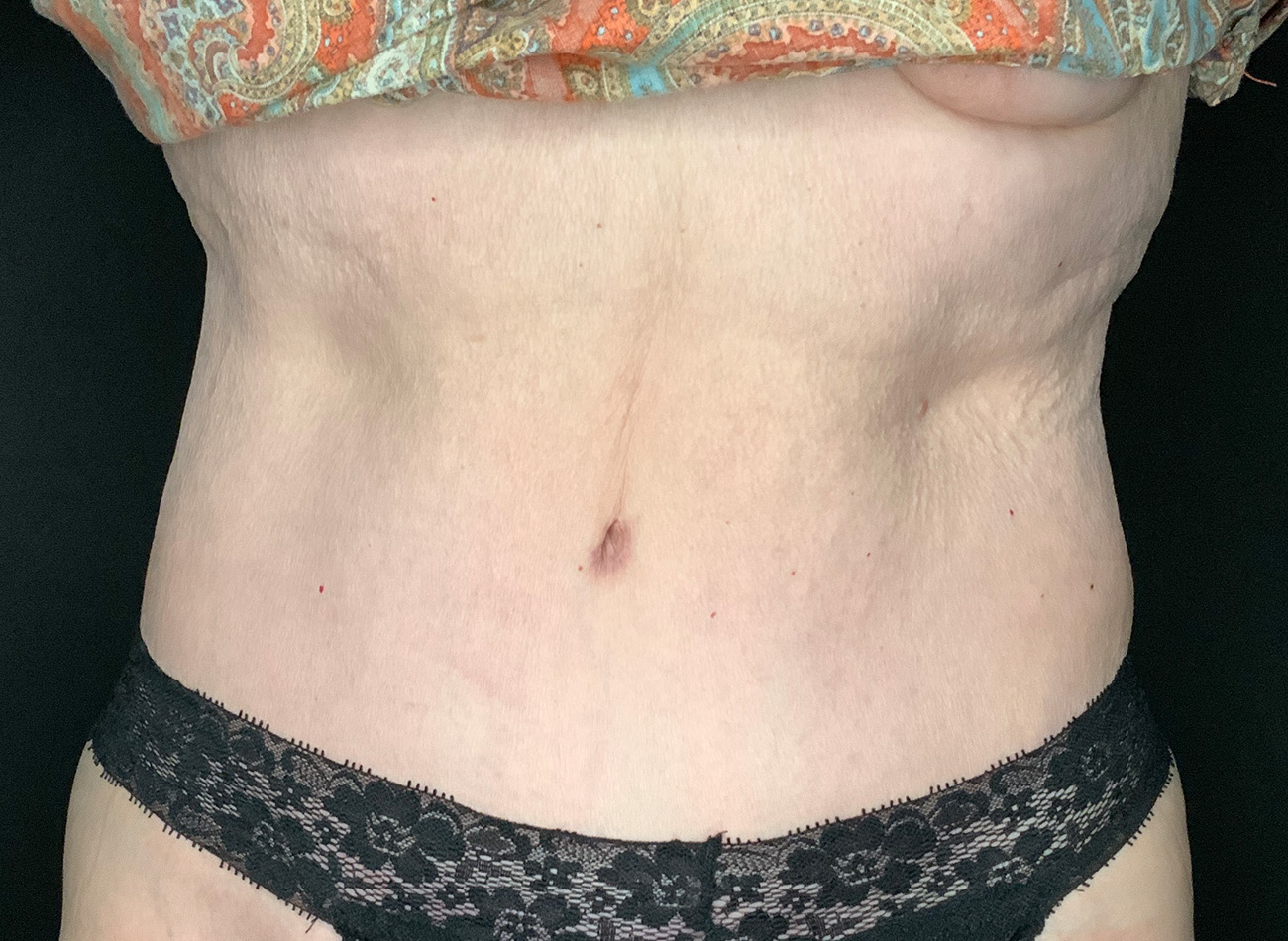 Patient #90245: Tummy Tuck After Image