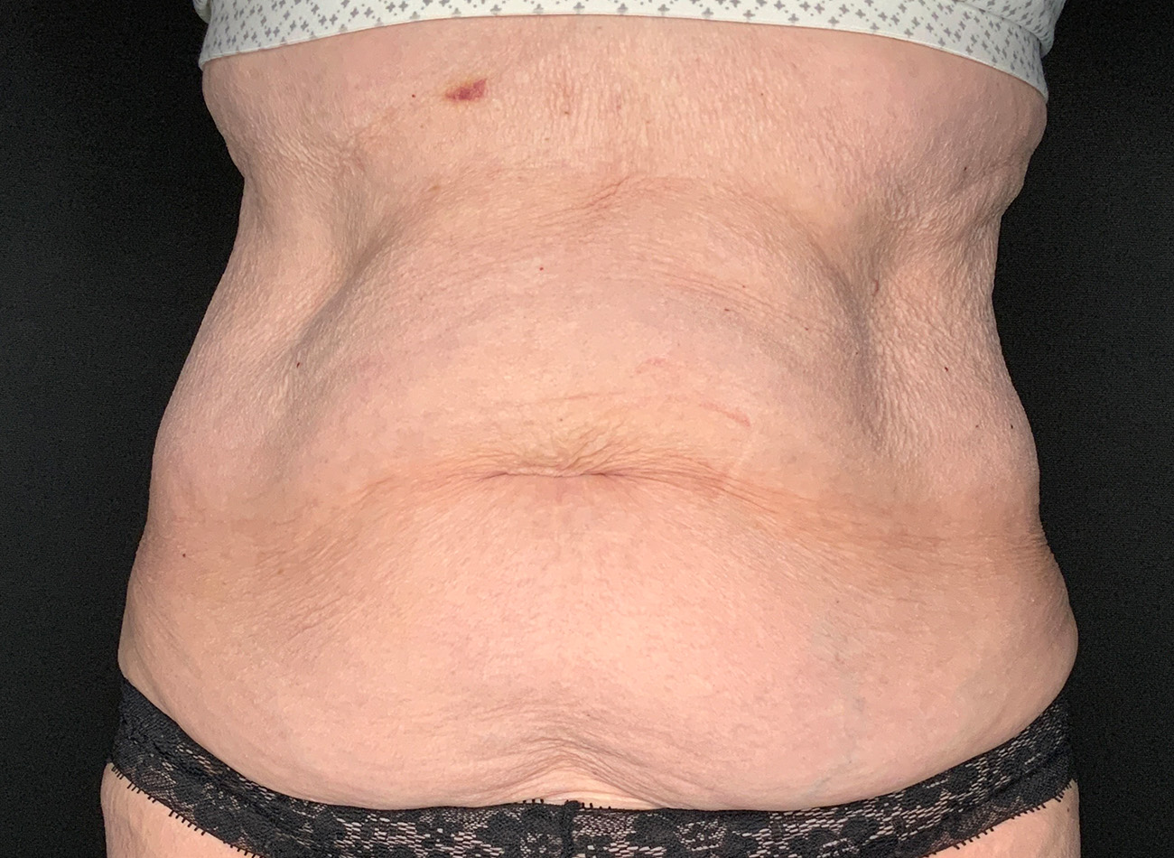Patient #90245: Tummy Tuck Before Image