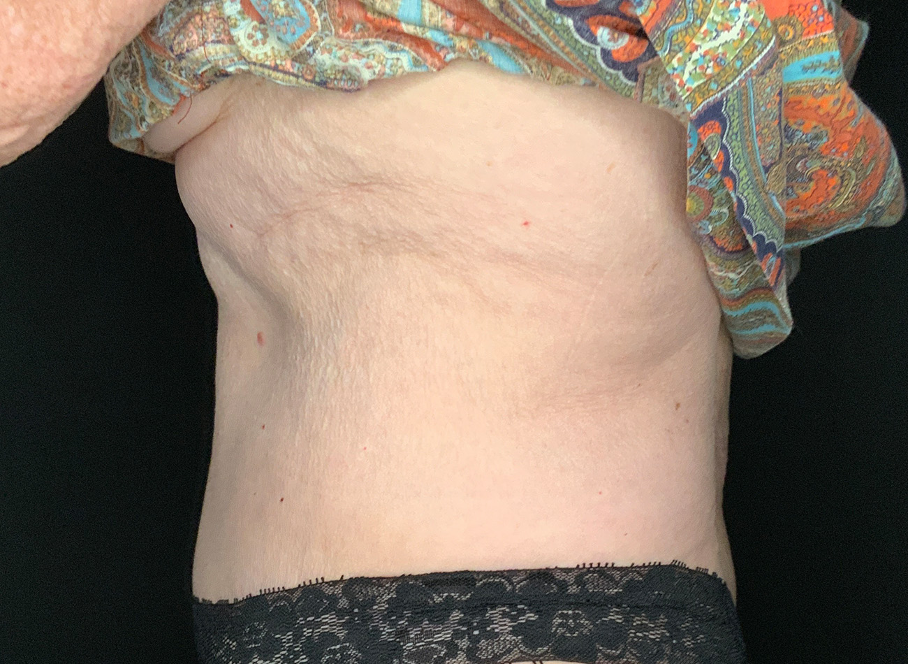 Patient #90245: Tummy Tuck After Image
