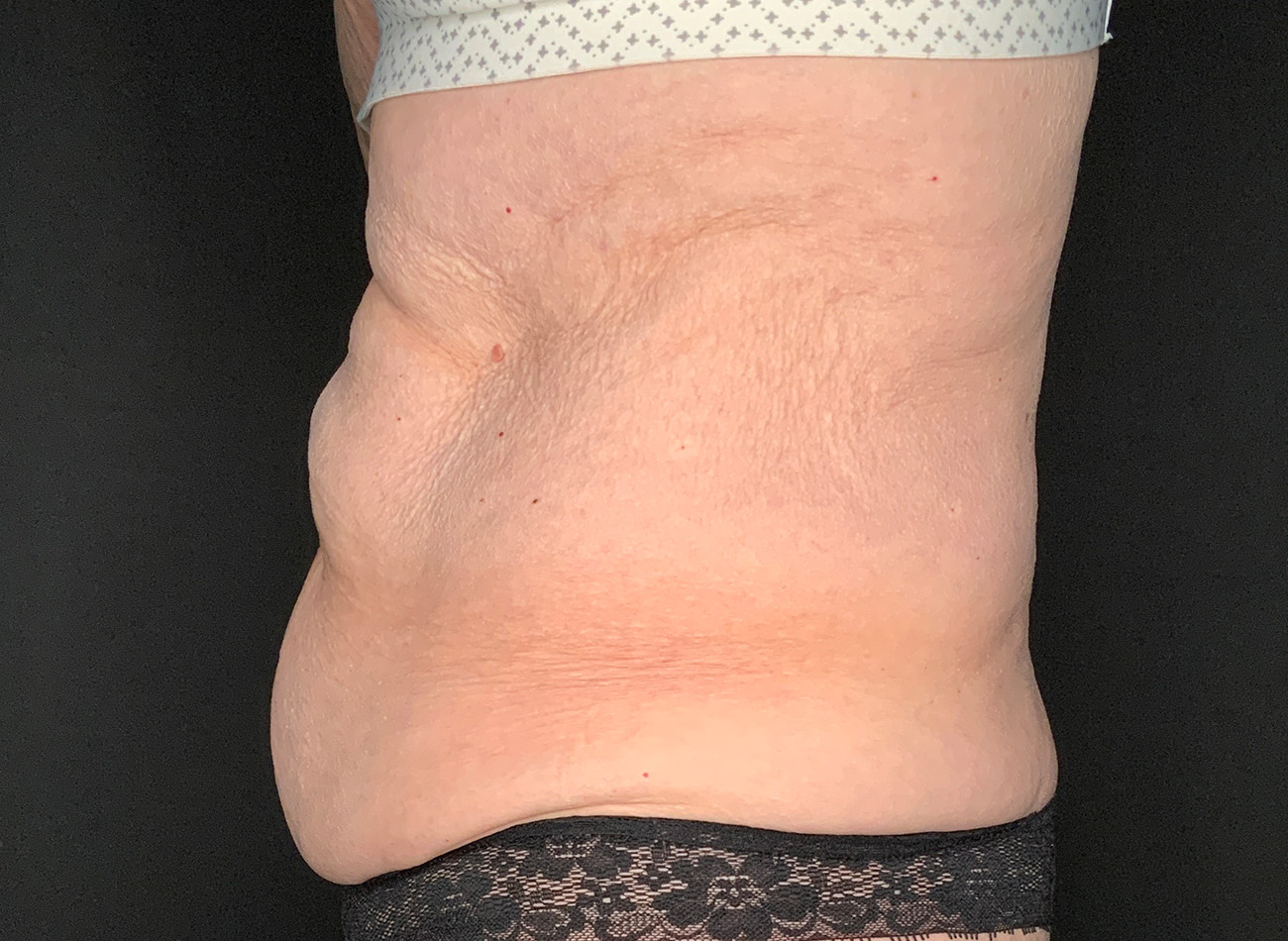 Patient #90245: Tummy Tuck Before Image