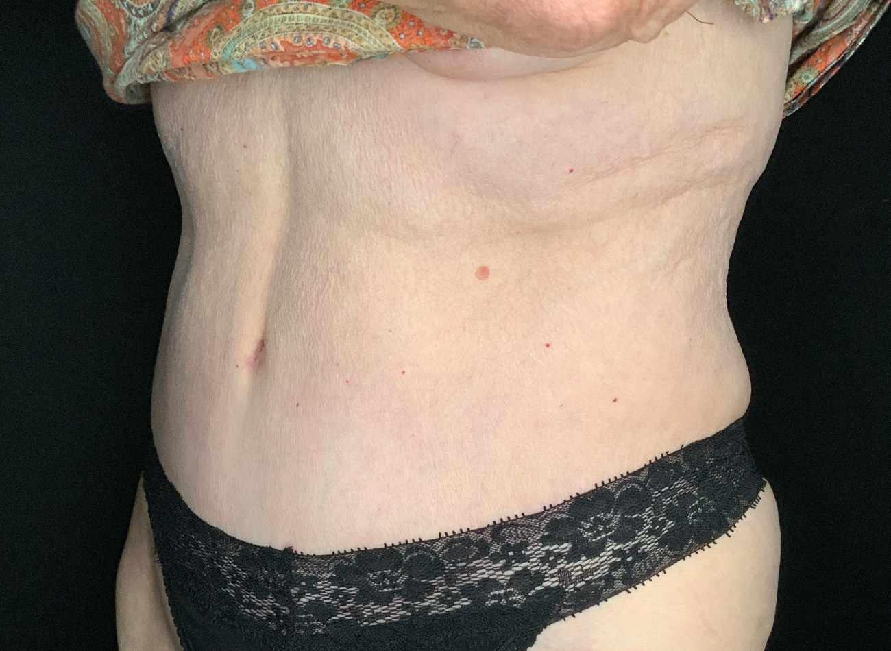 Patient #90245: Tummy Tuck After Image