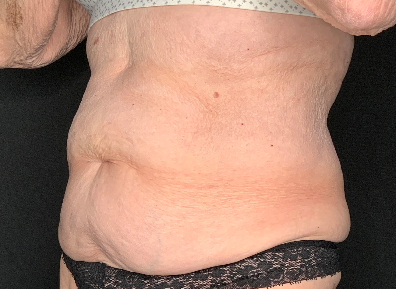 Patient #90245: Tummy Tuck Before Image
