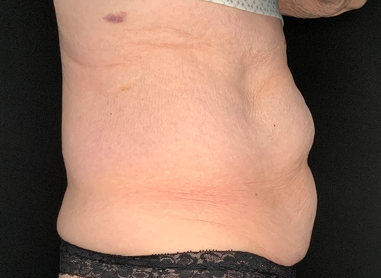 Patient #90245: Tummy Tuck Before Image