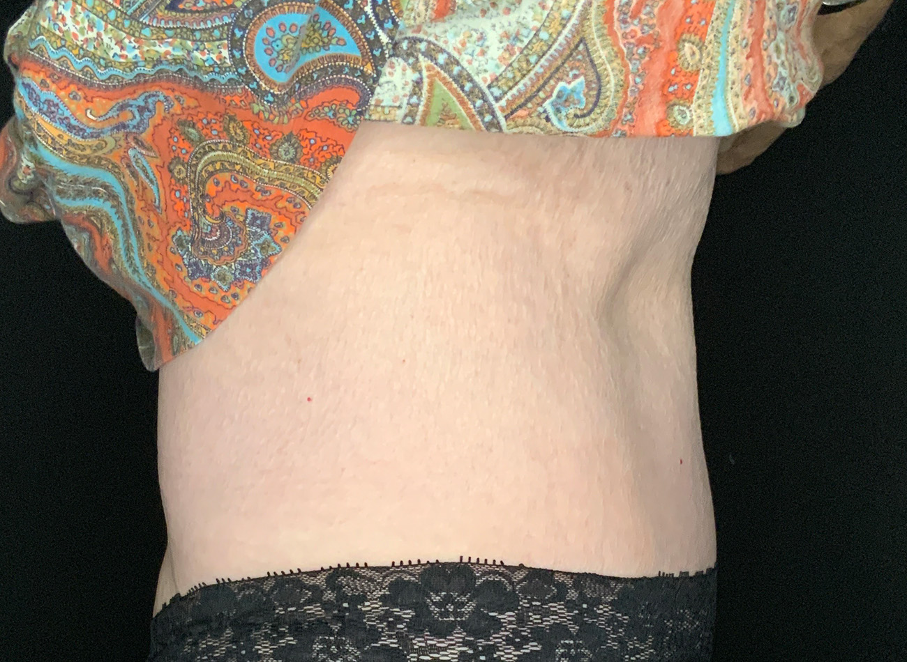Patient #90245: Tummy Tuck After Image
