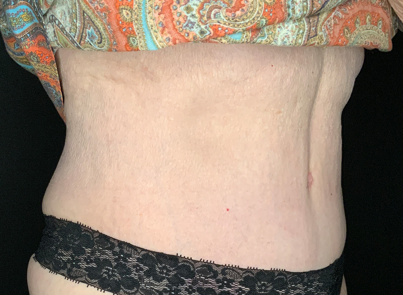 Patient #90245: Tummy Tuck After Image