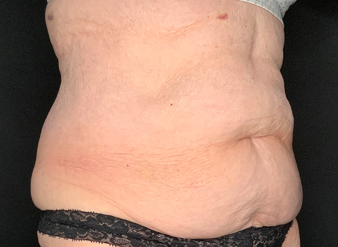 Patient #90245: Tummy Tuck Before Image
