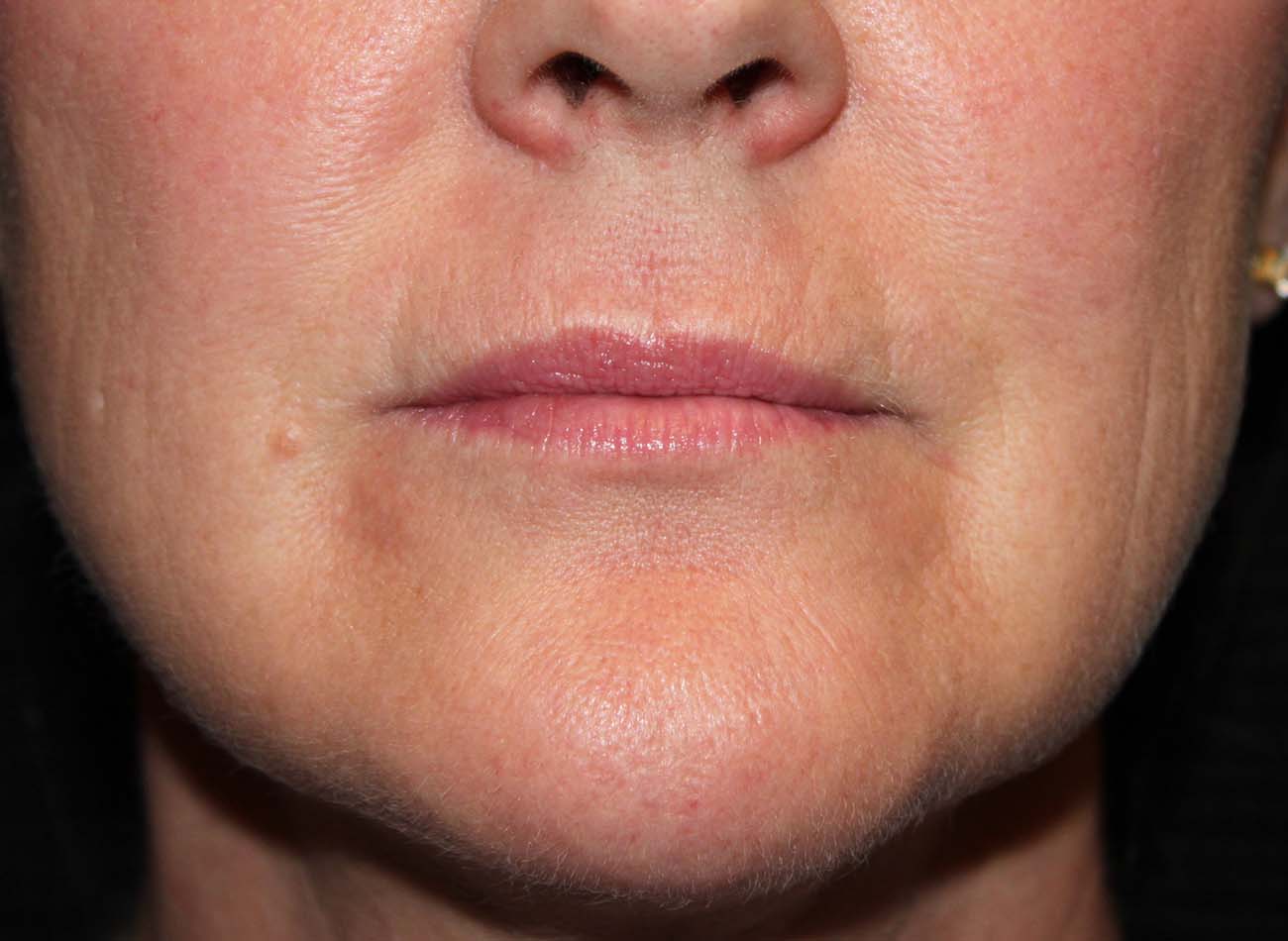 Patient #22082: Ablative Perioral Before Image