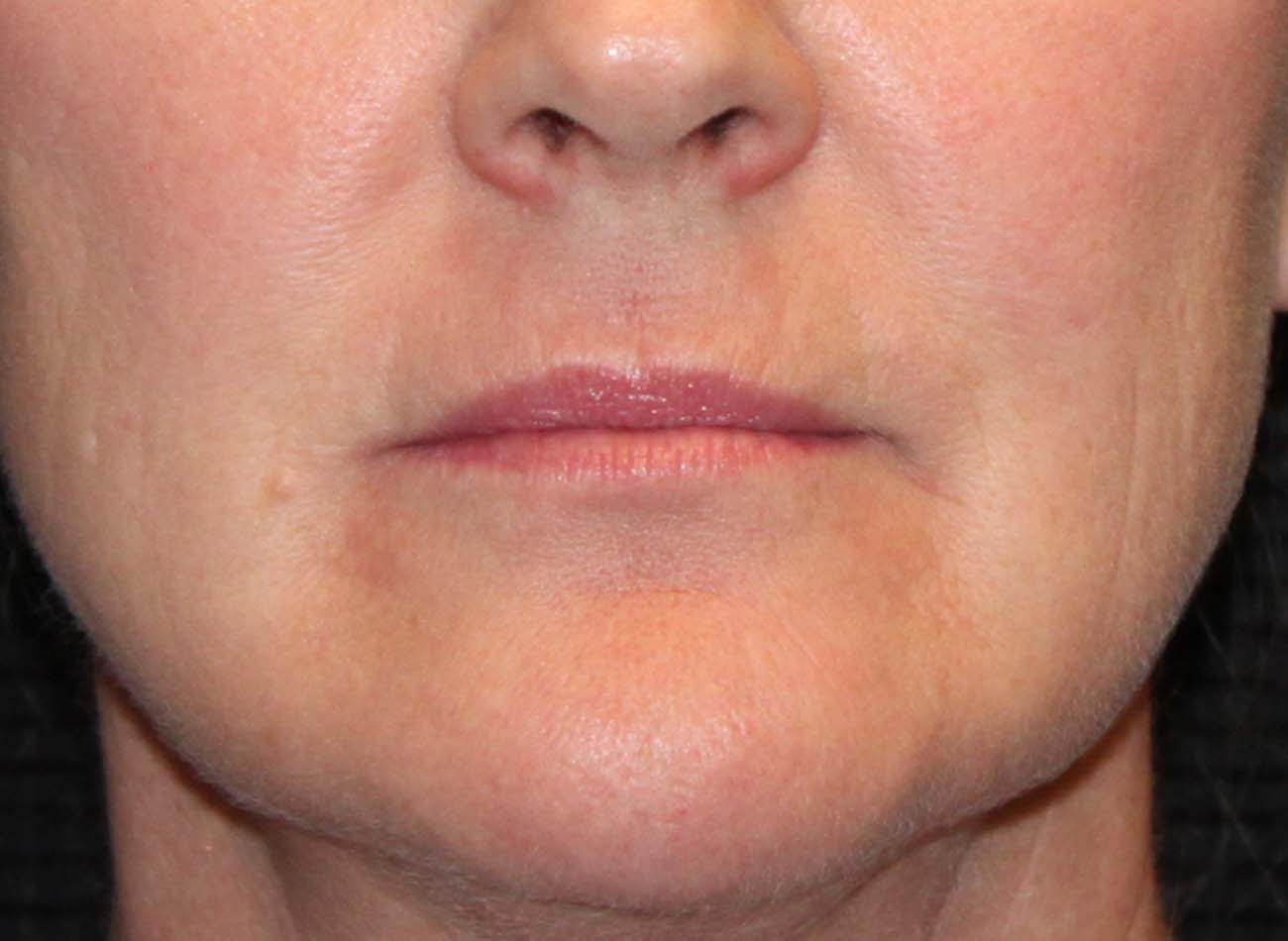 Patient #22082: Ablative Perioral After Image