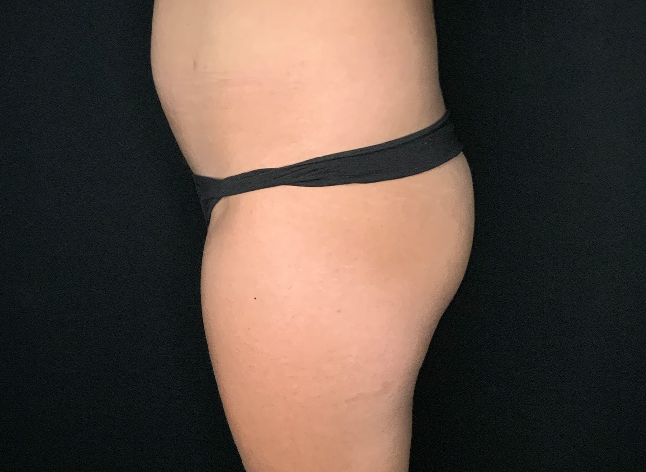 Patient #69141-2: Brazilian Butt Lift Before Image