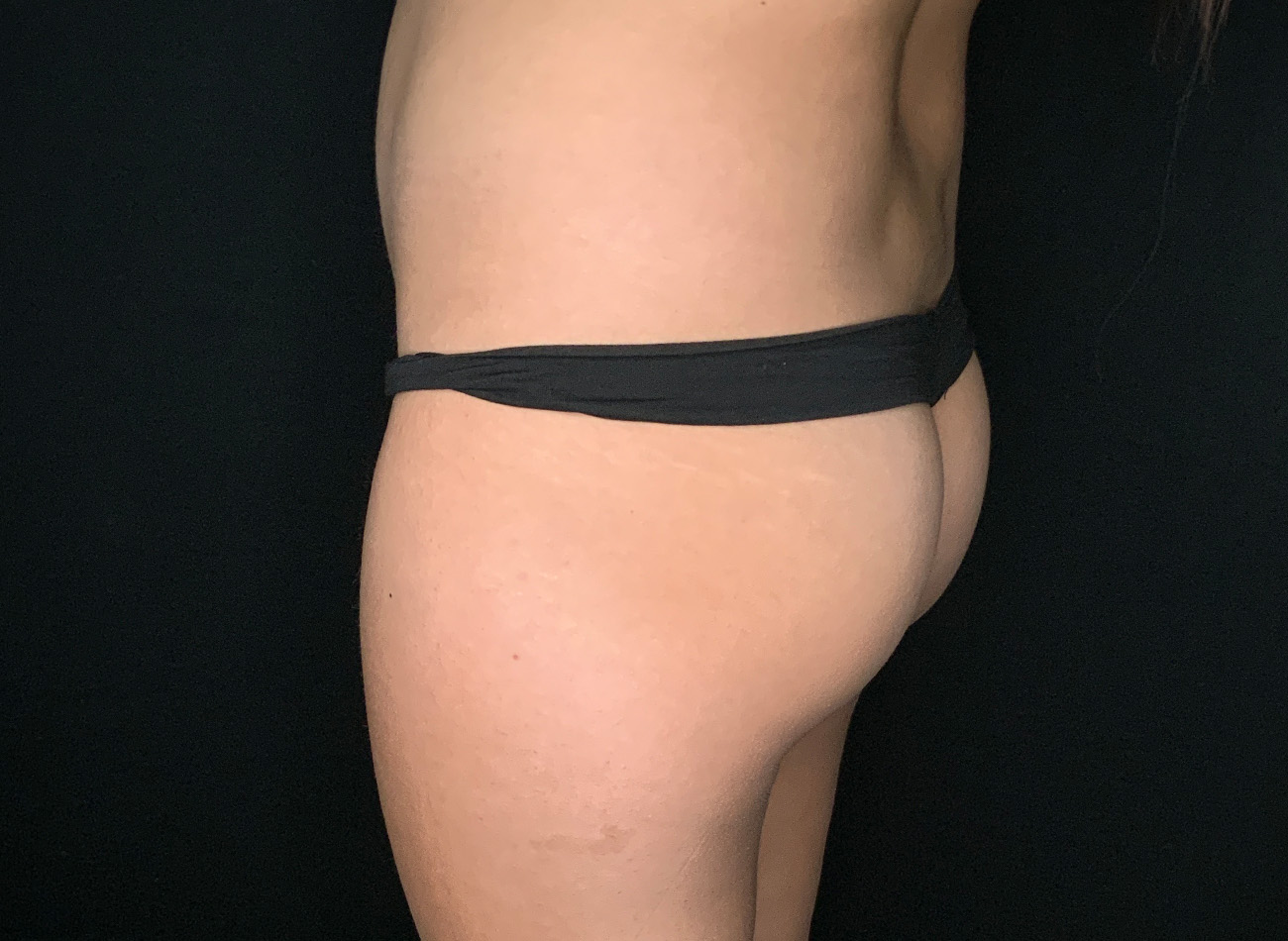 Patient #69141-2: Brazilian Butt Lift Before Image