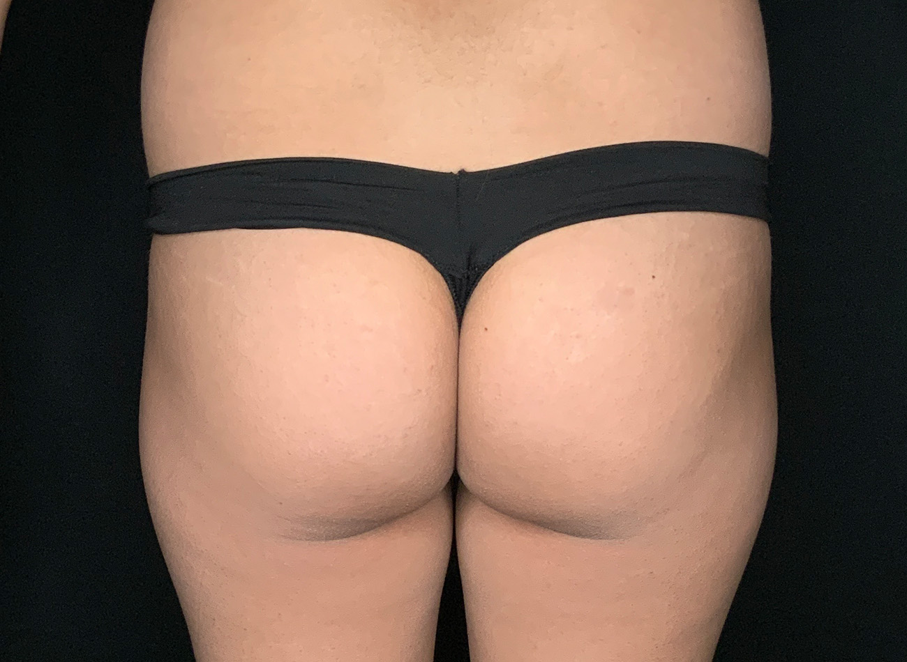 Patient #69141-2: Brazilian Butt Lift Before Image