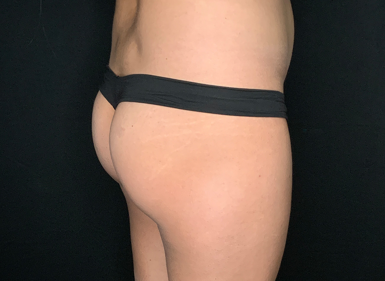 Patient #69141-2: Brazilian Butt Lift Before Image