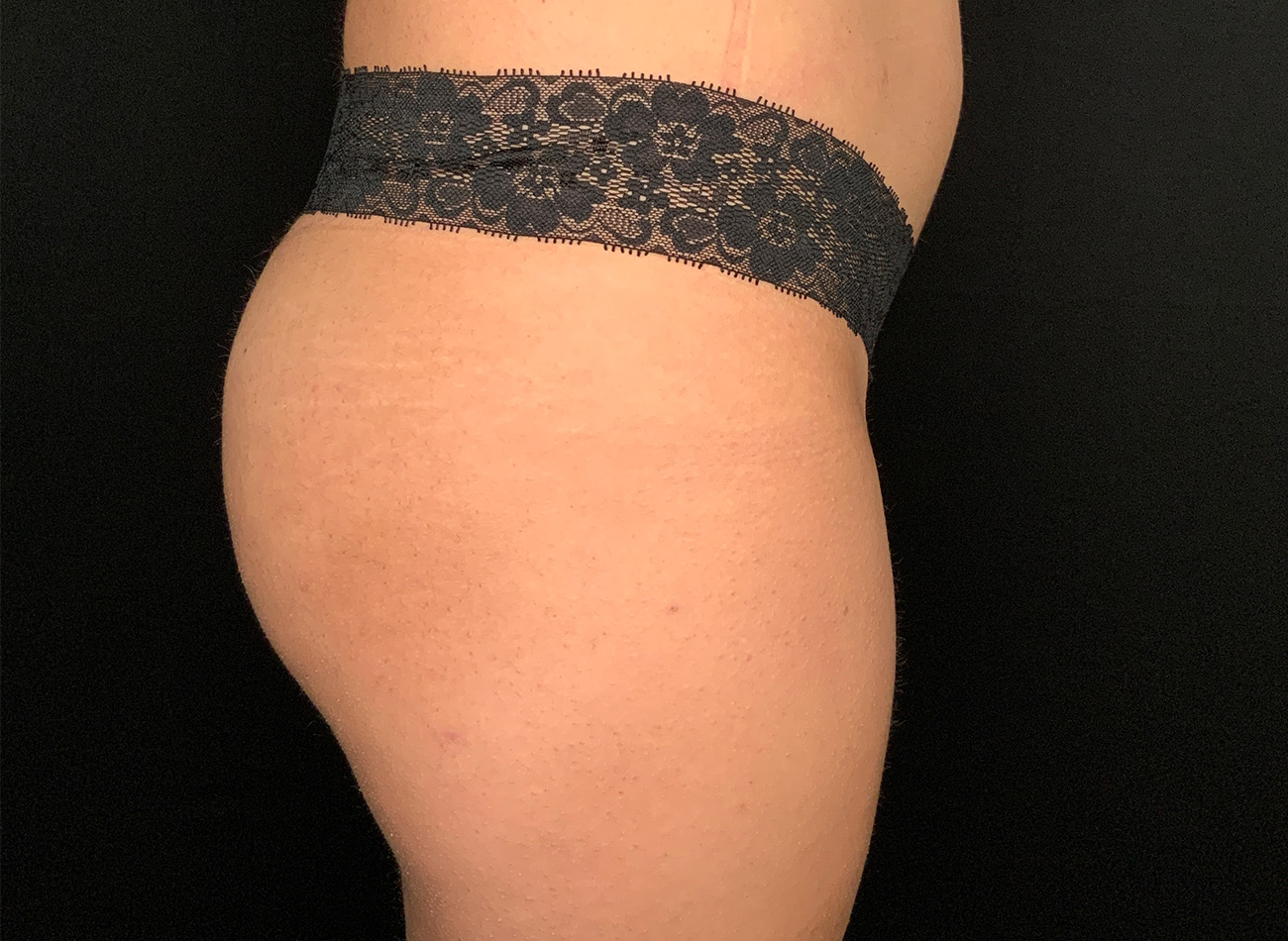 Patient #69141-2: Brazilian Butt Lift After Image