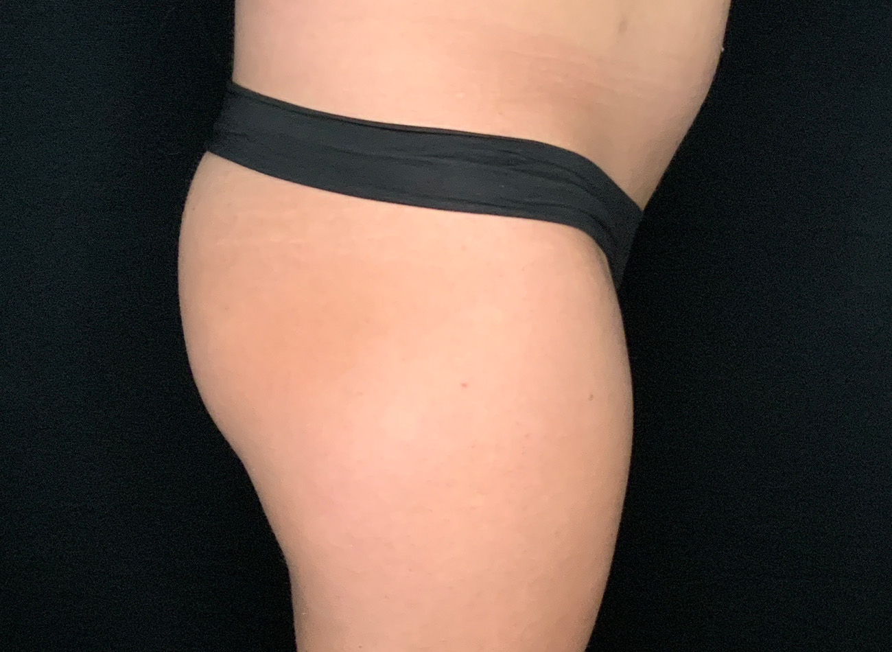 Patient #69141-2: Brazilian Butt Lift Before Image