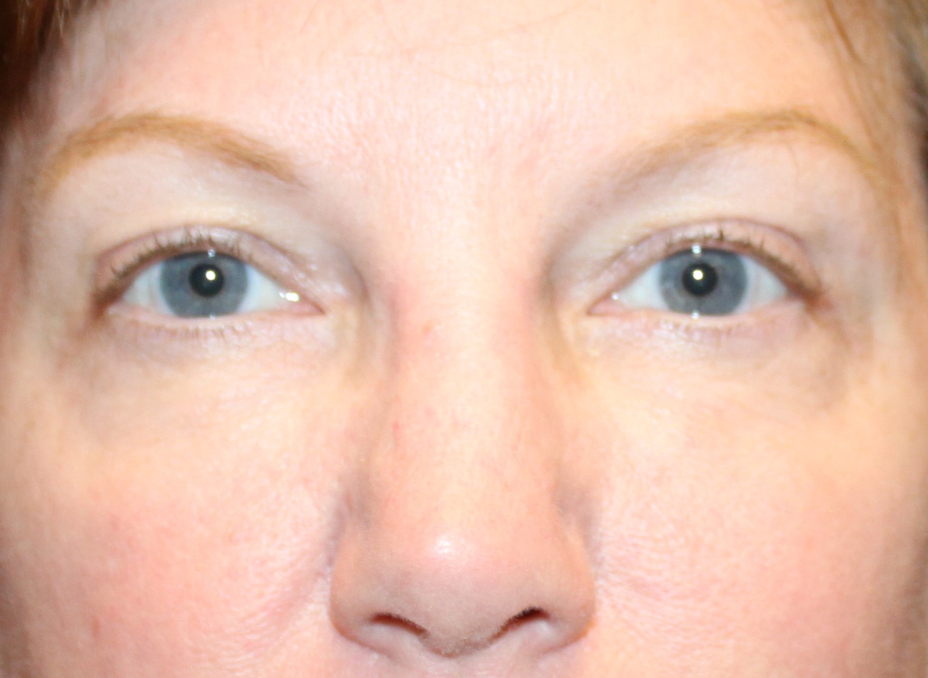 Patient #15028: Blepharoplasty After Image