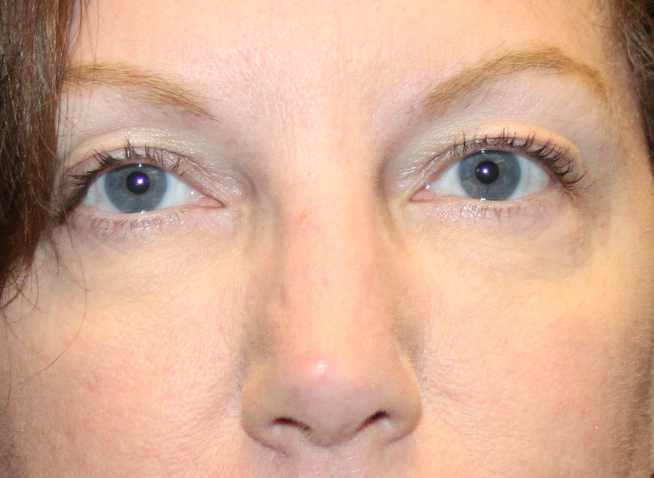 Patient #15028: Blepharoplasty Before Image
