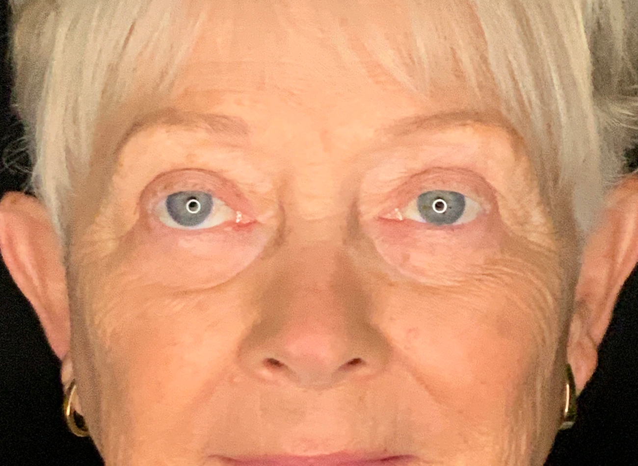 Patient #46607: Blepharoplasty After Image