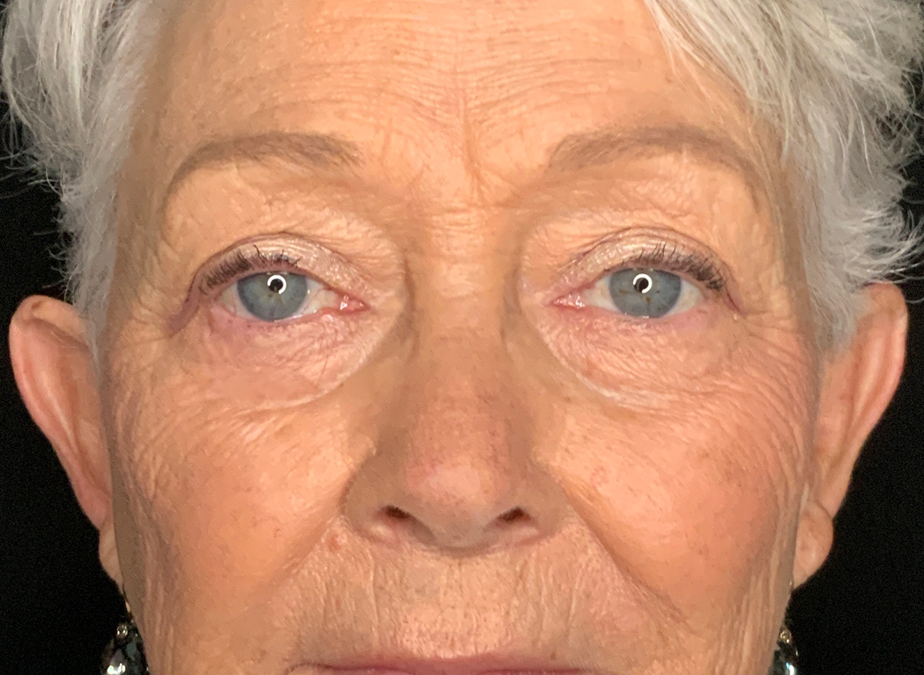 Patient #46607: Blepharoplasty Before Image