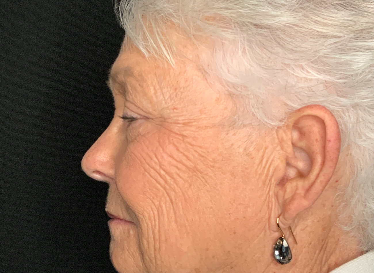 Patient #46607: Blepharoplasty Before Image