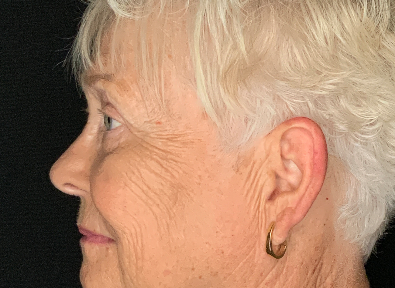 Patient #46607: Blepharoplasty After Image