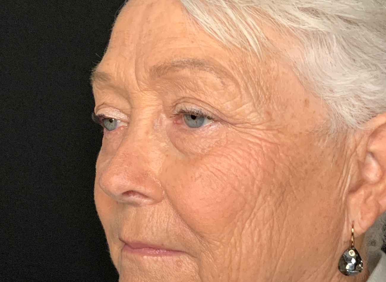 Patient #46607: Blepharoplasty Before Image