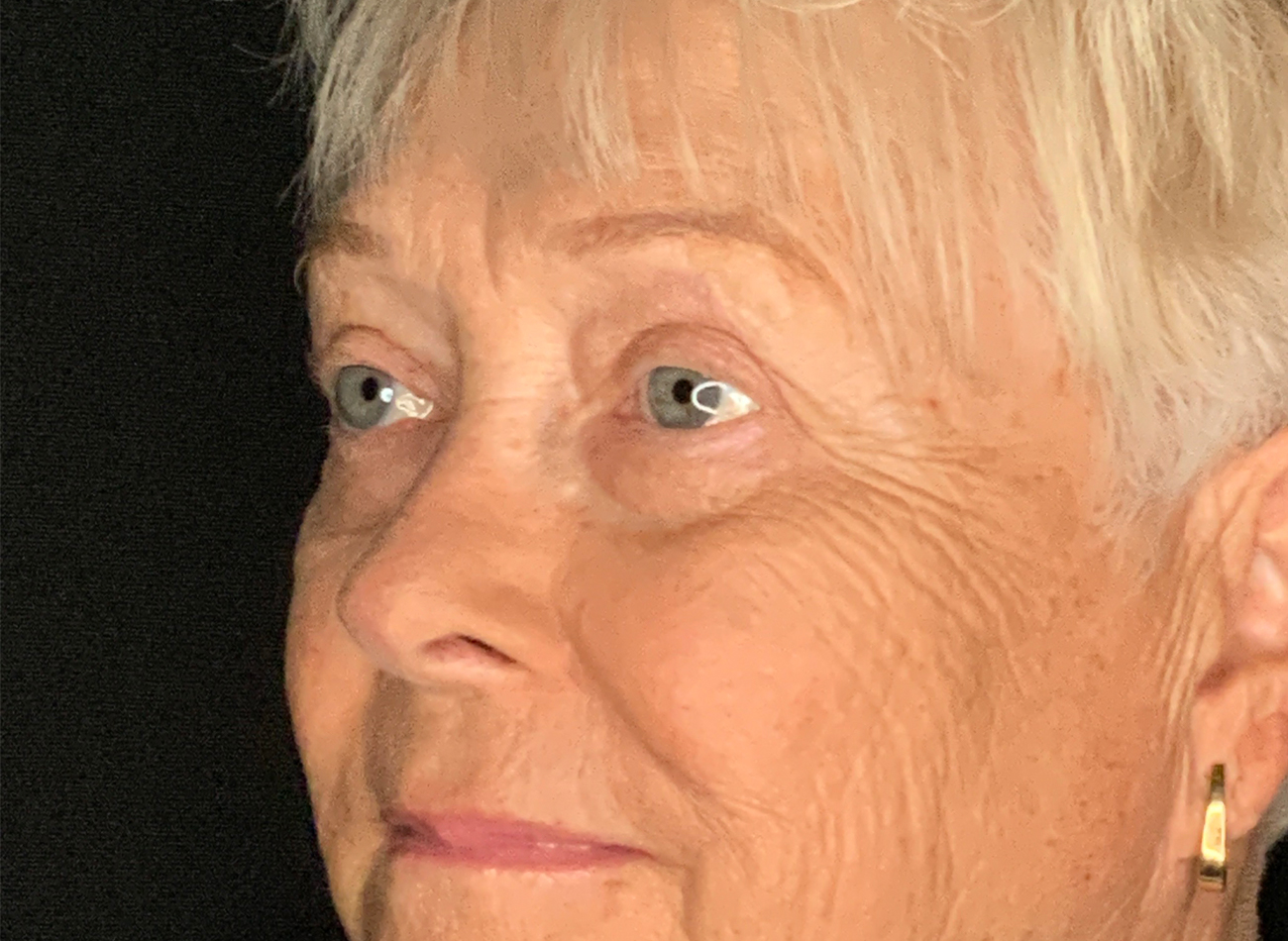 Patient #46607: Blepharoplasty After Image