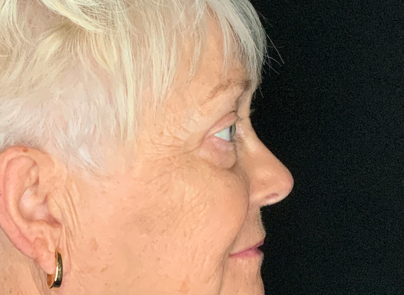 Patient #46607: Blepharoplasty After Image