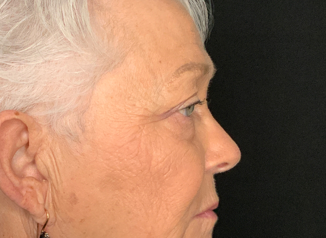 Patient #46607: Blepharoplasty Before Image
