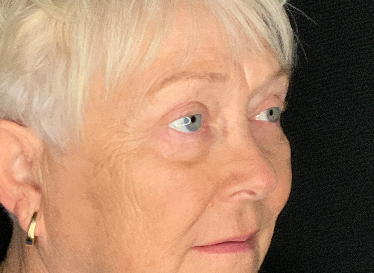 Patient #46607: Blepharoplasty After Image