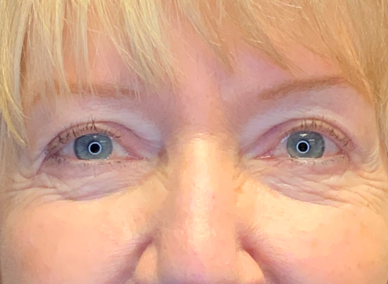 Patient #53777: Blepharoplasty After Image