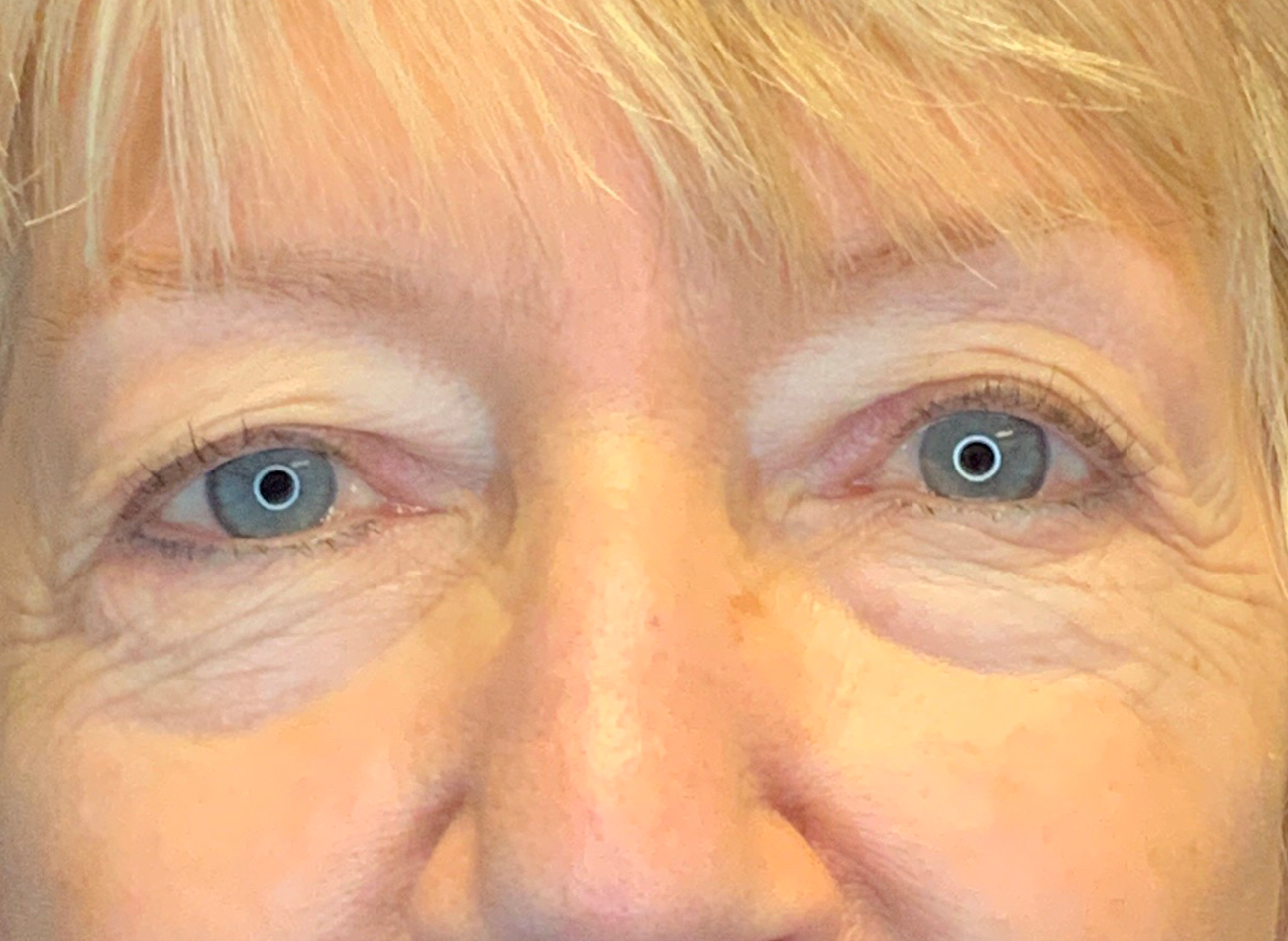 Patient #53777: Blepharoplasty Before Image