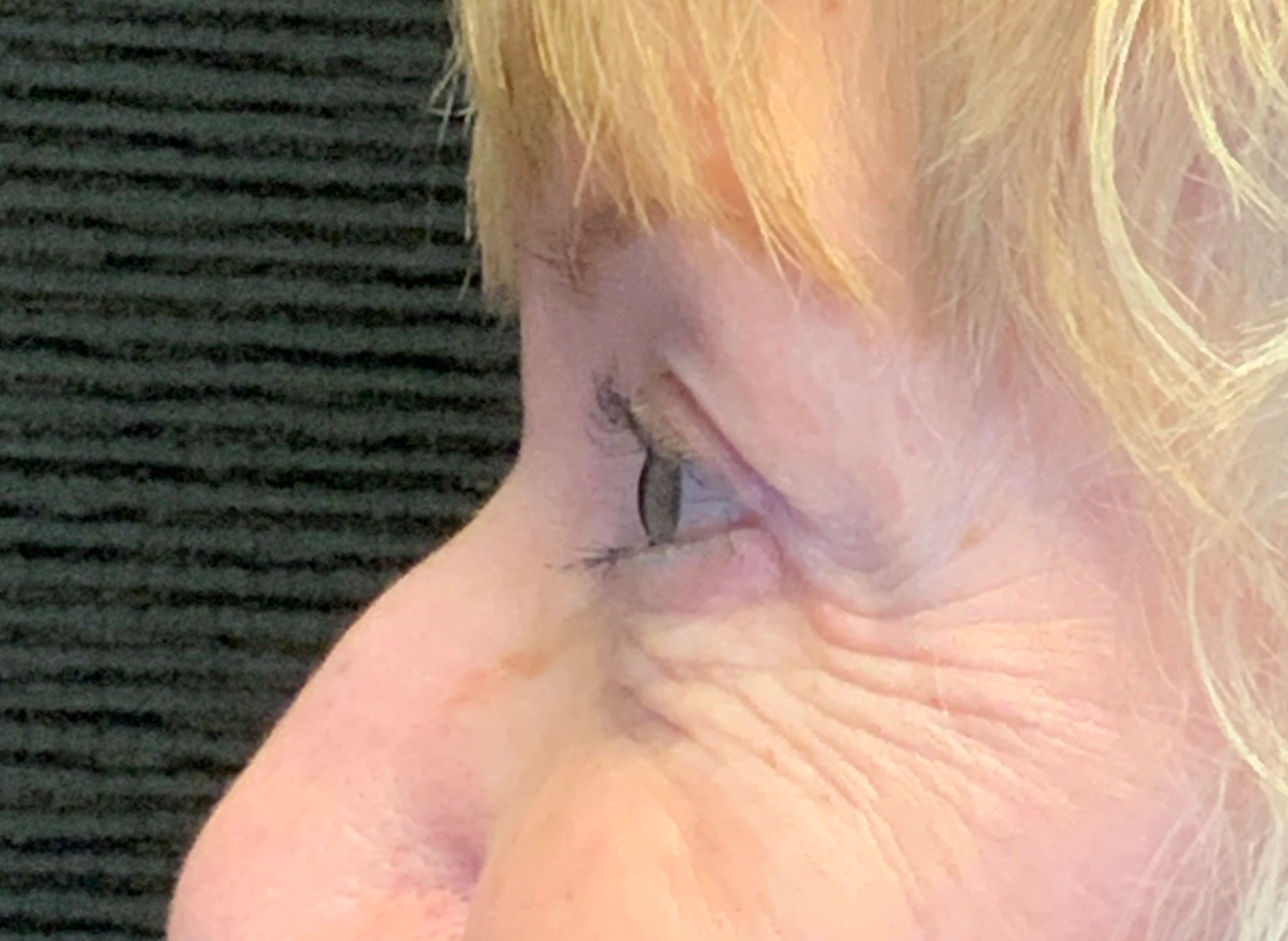 Patient #53777: Blepharoplasty After Image