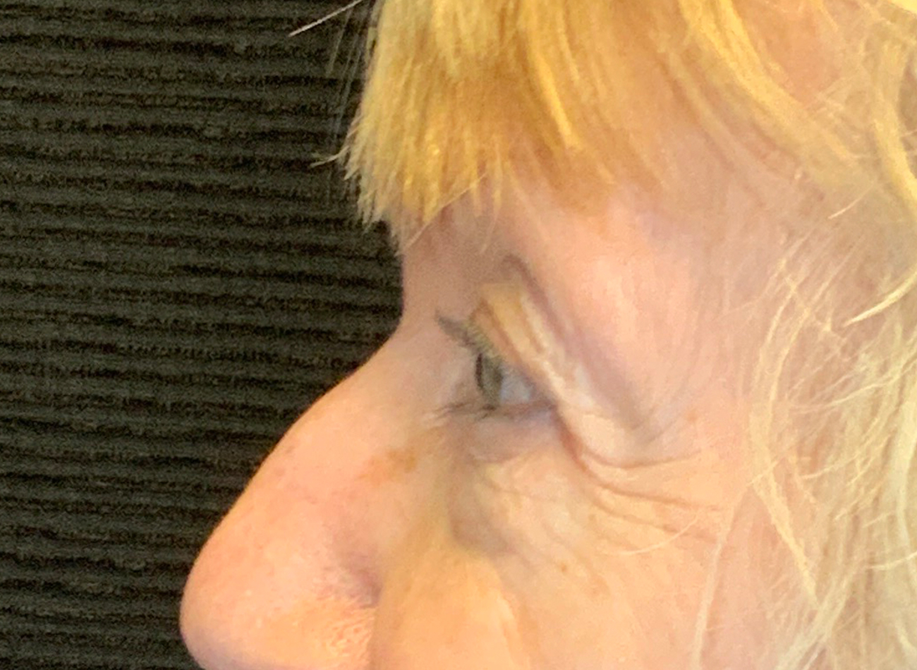 Patient #53777: Blepharoplasty Before Image