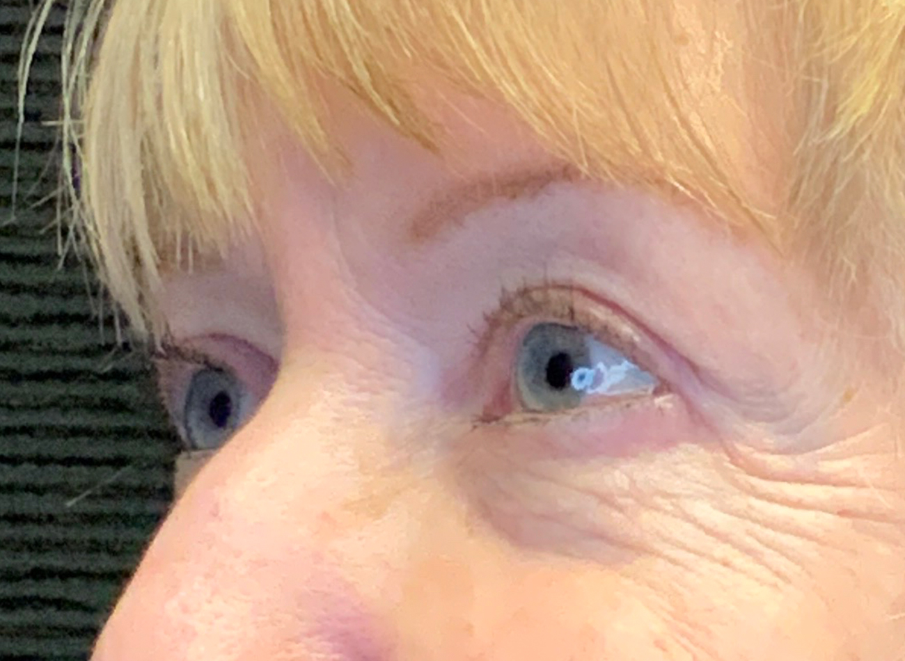 Patient #53777: Blepharoplasty After Image