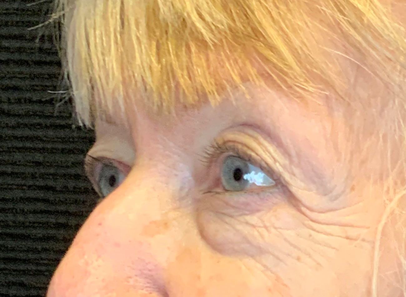 Patient #53777: Blepharoplasty Before Image