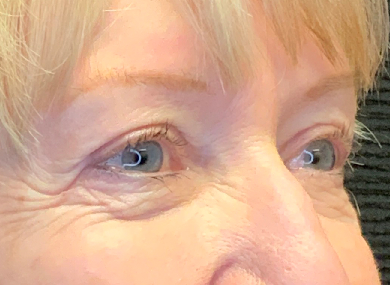 Patient #53777: Blepharoplasty After Image