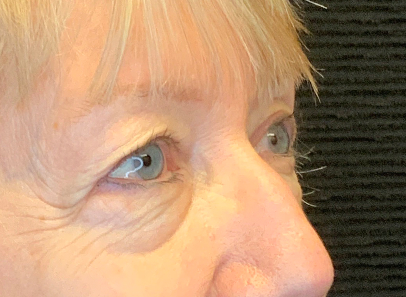 Patient #53777: Blepharoplasty Before Image