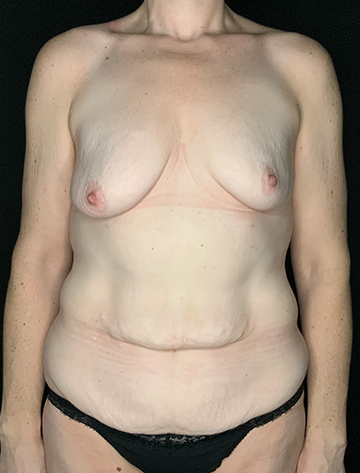 Patient #57914: Bodylift Before Image