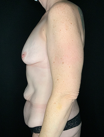 Patient #57914: Bodylift Before Image