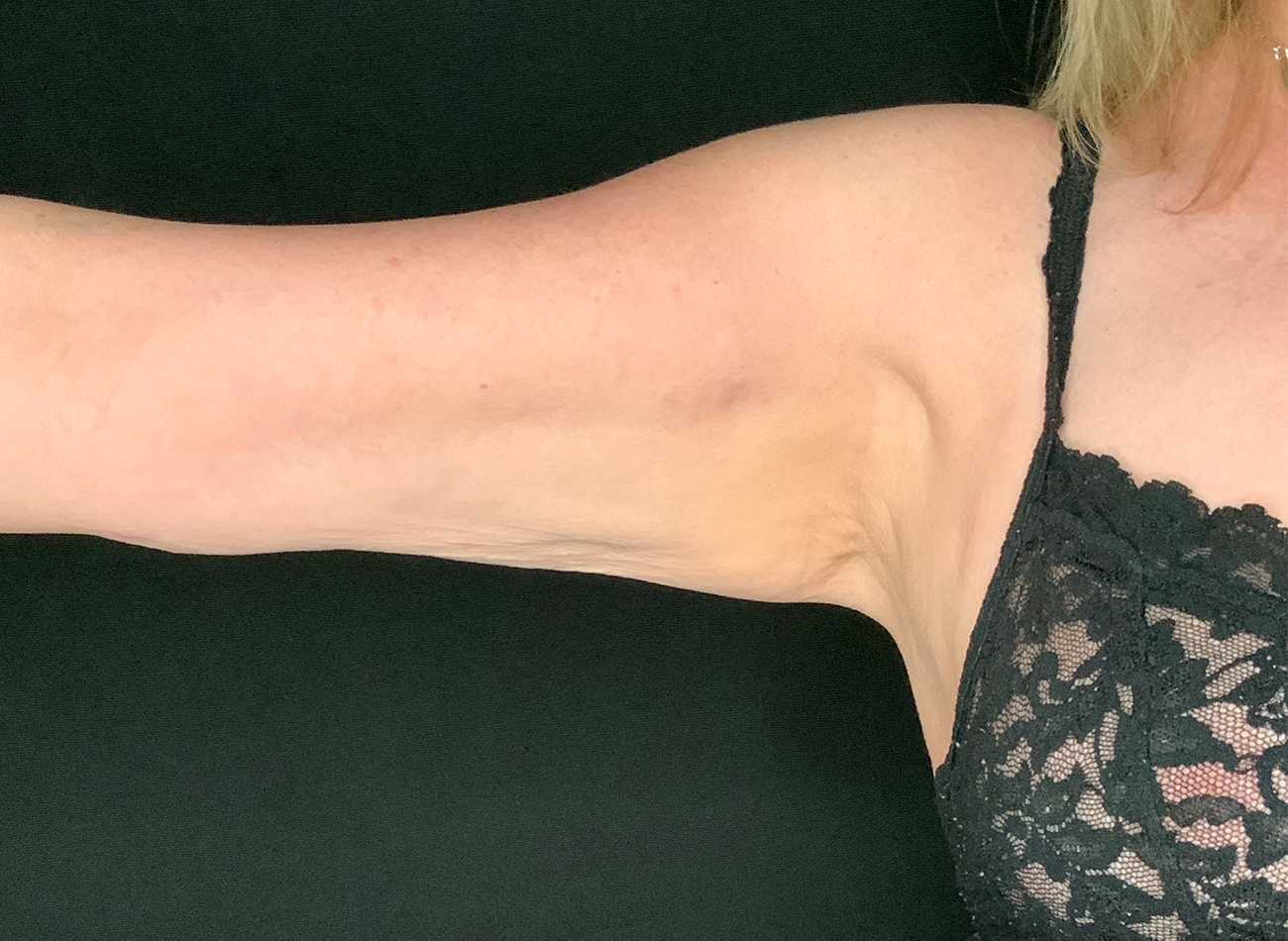 Patient #74261: BodyTite After Image